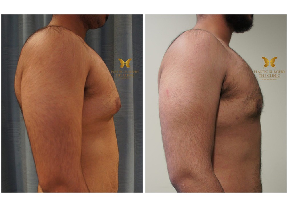 Gynaecomastia surgery before and after 01, TPSC Sydney & Central Coast, side view
