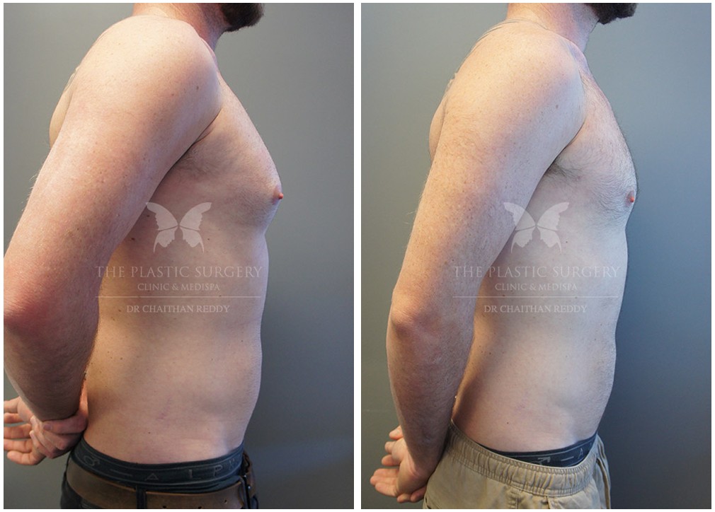Gynaecomastia surgery before and after 11, TPSC