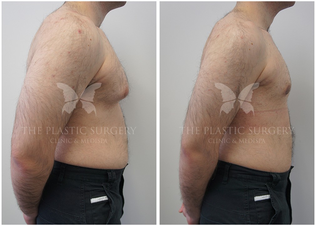Gynecomastia surgery before and after 17, Dr Reddy