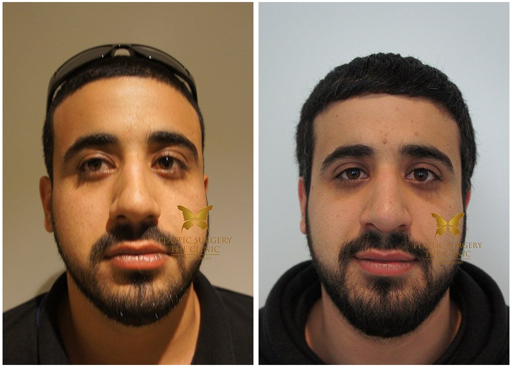 Male patient before and after nose job 17, Dr Reddy clinic Sydney