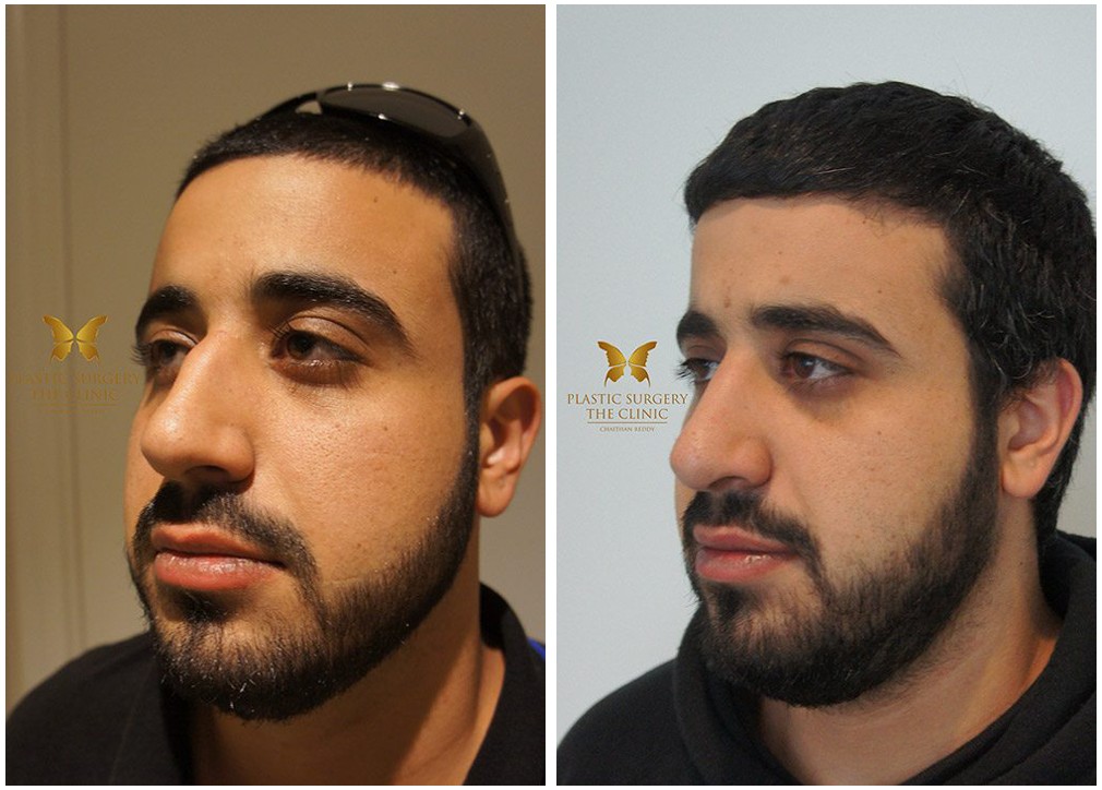 Rhinoplasty results, male patient, before and after 18, angle view, Dr Reddy Sydney