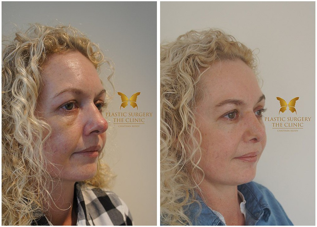 Rhinoplasty patient, before and after (results) 20, TPSC