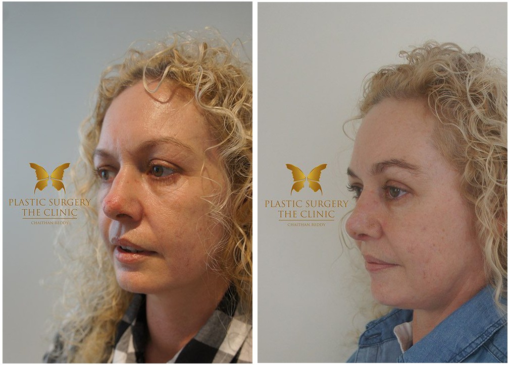 Before and afters, female patient, Rhinoplasty surgery results 22