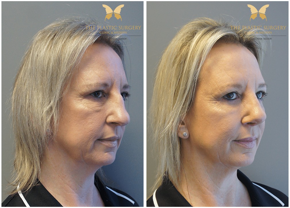 Before and after nose job 27, angle view, female patient