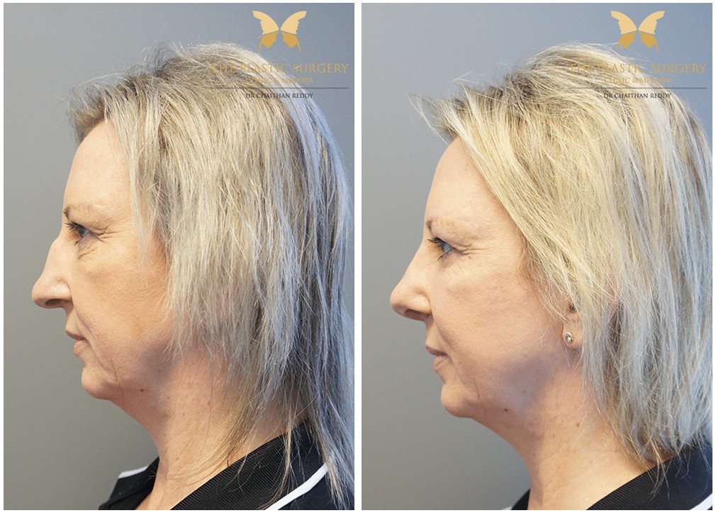Before and after Rhinoplasty 30, side view, Dr Reddy plastic surgery