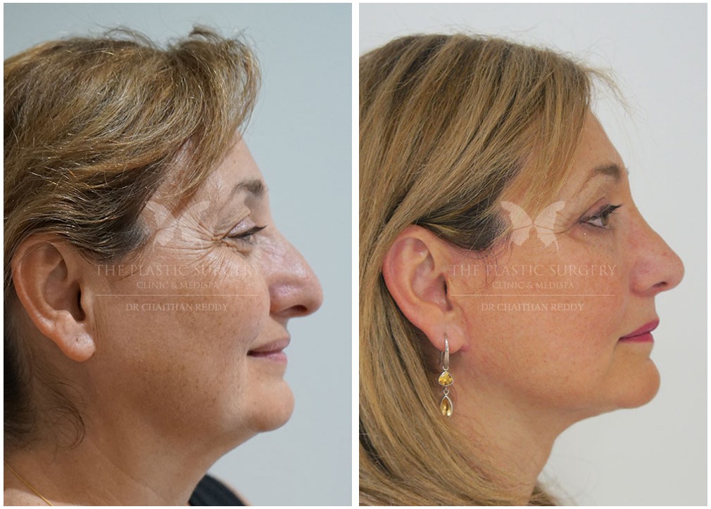 Female patient before and after nose job 49, Dr Reddy clinic Sydney