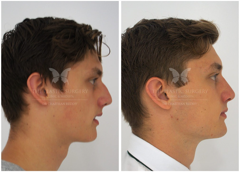 Male patient, before and after 52, TPSC