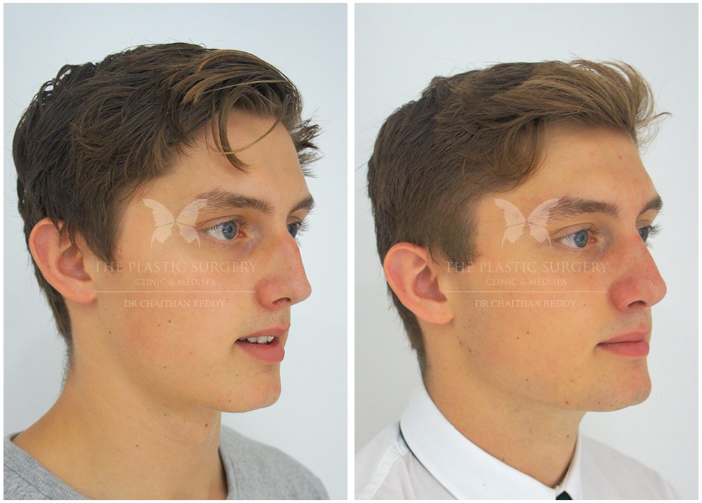 Young male patient before and after nose job 53, TPSC