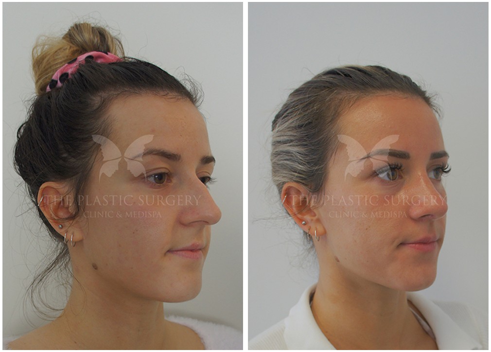 Nose job (Rhinoplasty) patient before and after procedure 65, TPSC