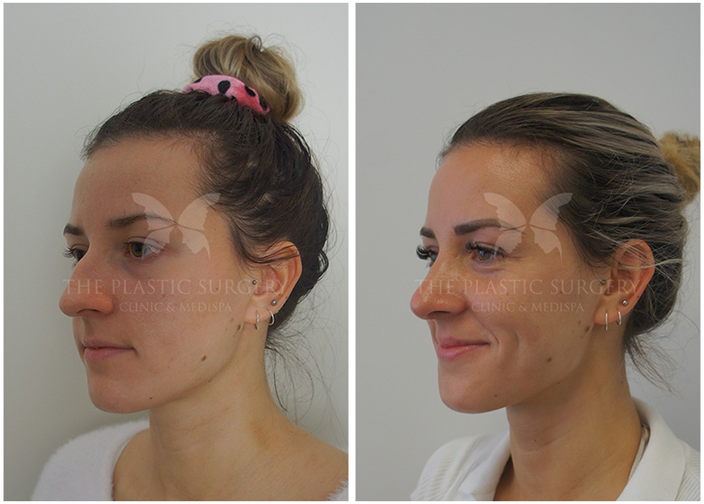 Rhinoplasty surgery results 67, female patient, angle view