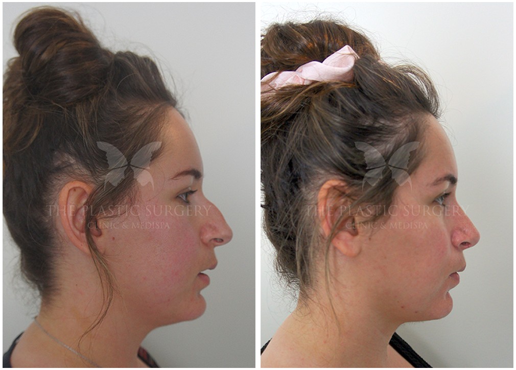 Before and after cosmetic nose surgery (Rhinoplasty) 68, TPSC