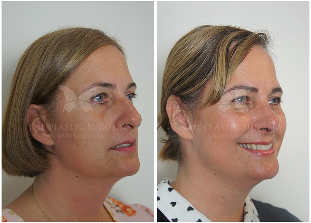 Nose job surgery before and after 78