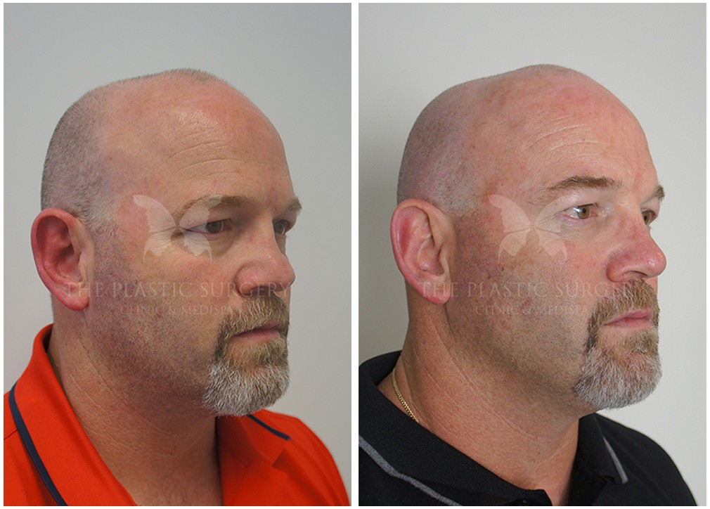 Nose job surgery results, male patient, before and after 07