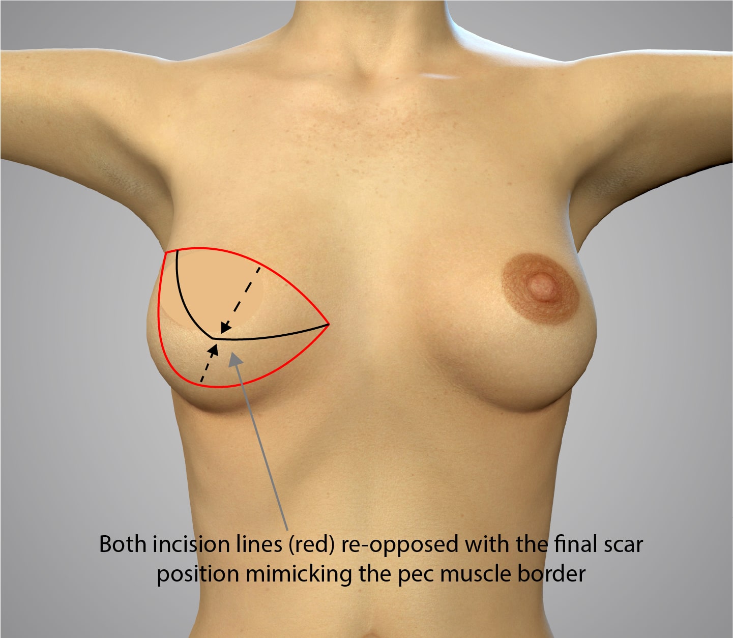 Top surgery, approach 01-2