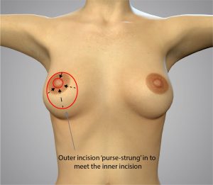 Top surgery, approach 02-2