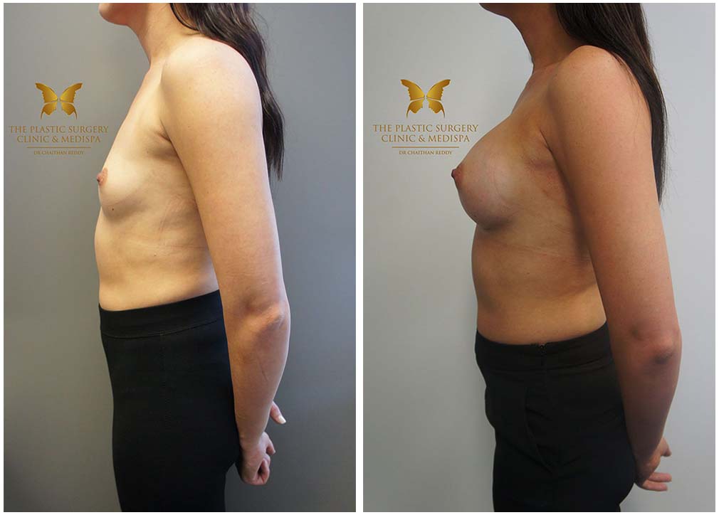 Before and after breast augmentation 8.1, Dr Chaithan Reddy