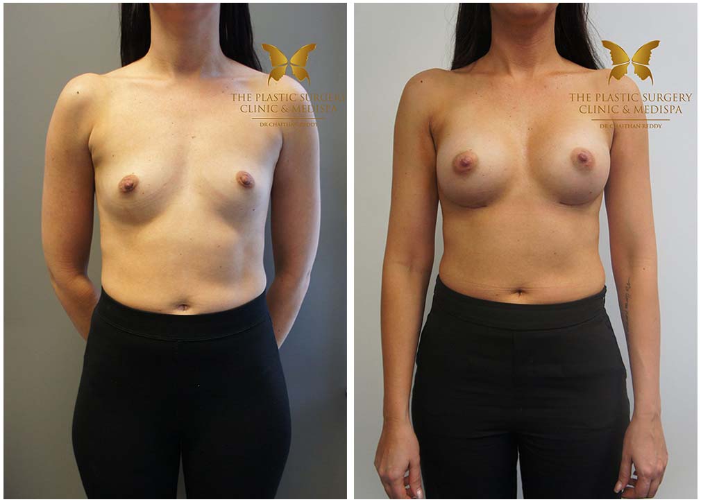 Patient before and after breast augmentation 08, Dr Chaithan Reddy
