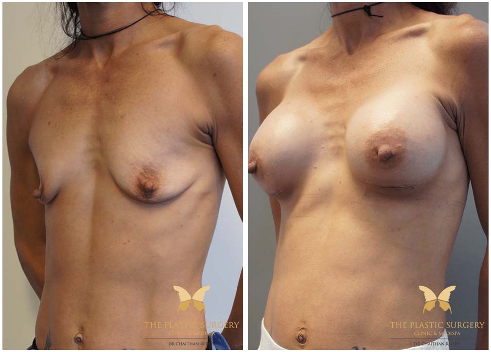 Breast augmentation with implants 9.1, Dr Reddy Sydney & Central Coast