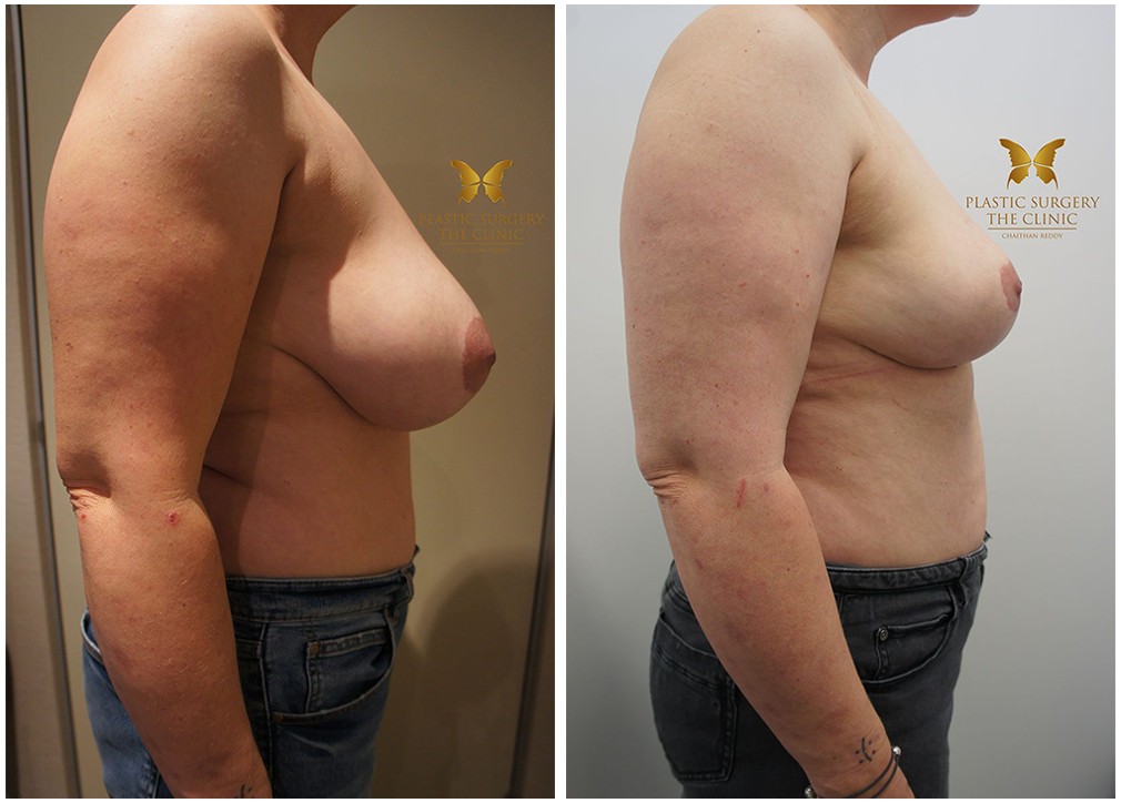 TPSC patient before and after breast reduction 07, Dr Chaithan Reddy