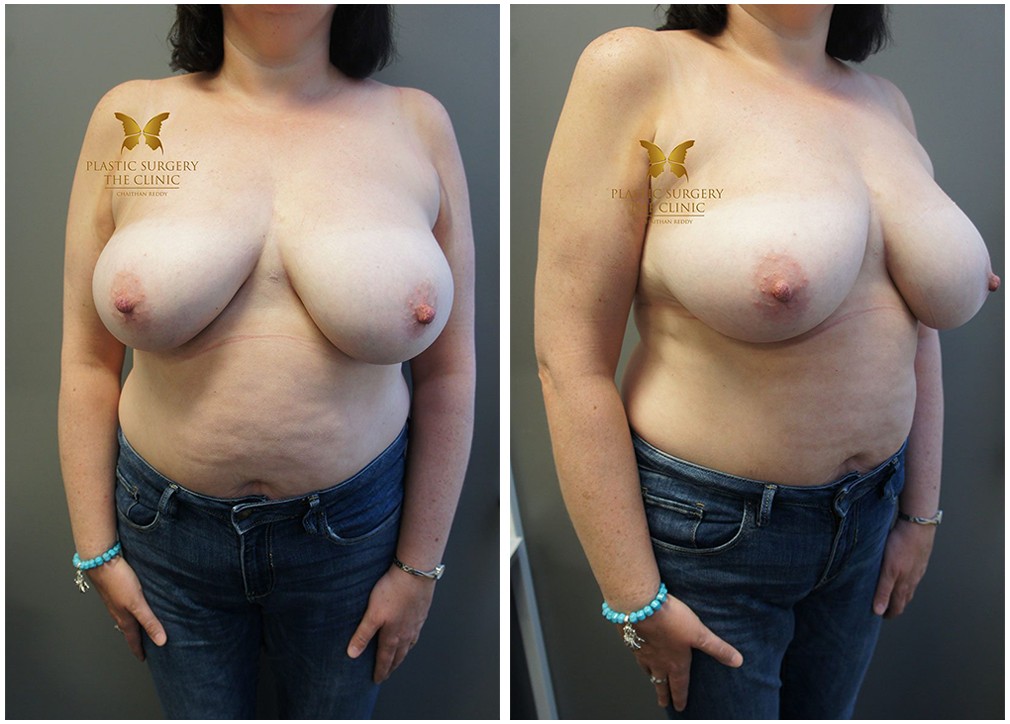 Before and after breast reduction surgery 14, TPSC