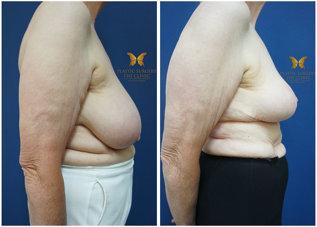 Before and afters 19, breast reduction surgery, Dr Reddy Sydney & Central Coast