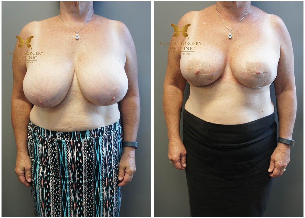 Breast reduction before and after 26, Dr Chaithan Reddy Sydney & Central Coast