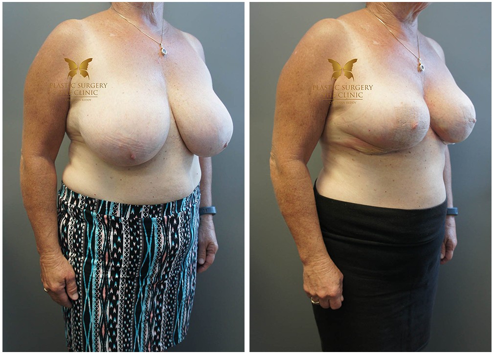 Dr Reddy breast reduction results 28