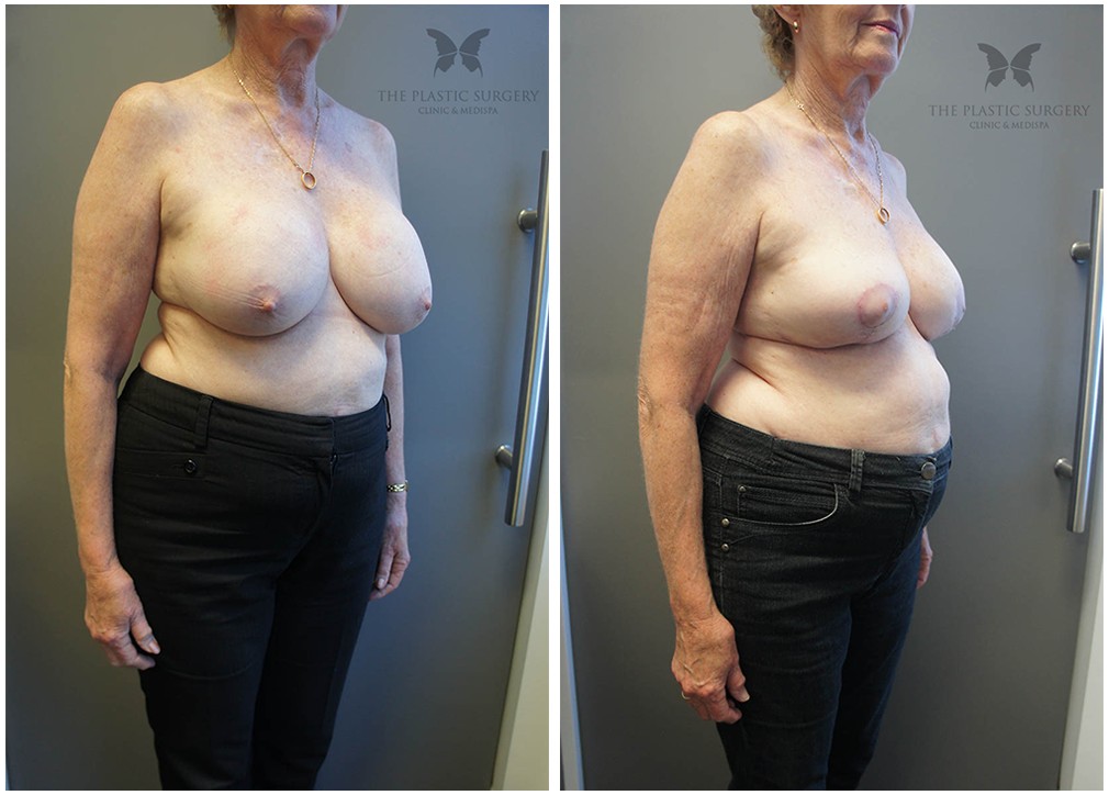 Breast reduction surgery results 31, angle view, Dr Reddy
