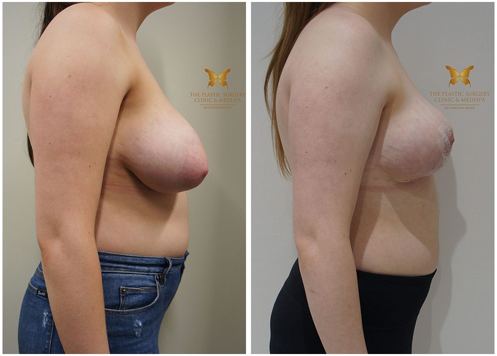 Before and after breast reduction 40, TPSC