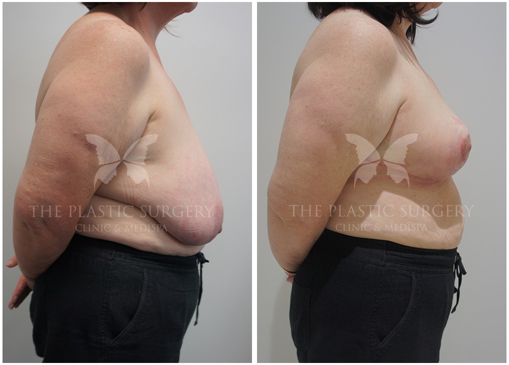 Before and after breast reduction 42, Dr Reddy