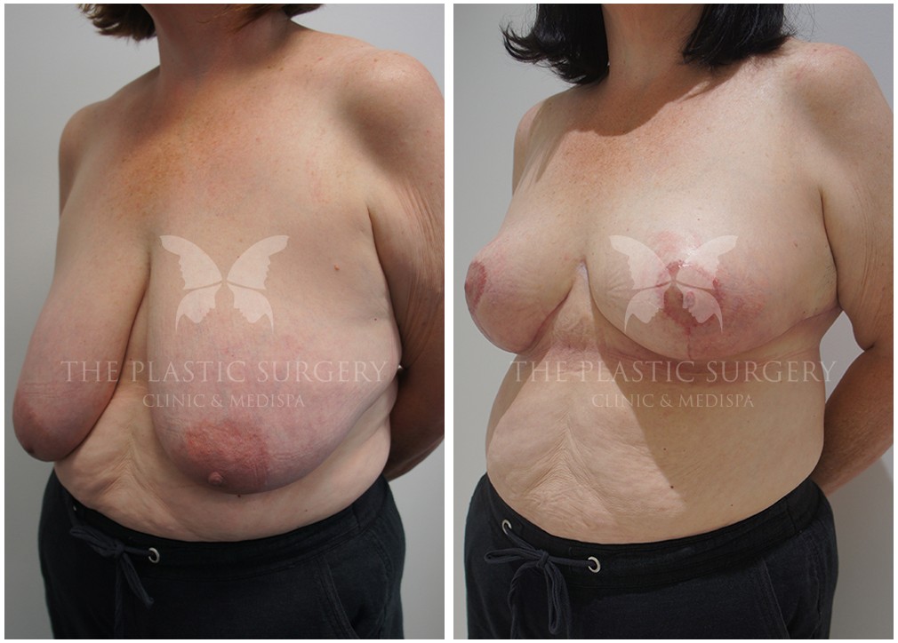 Before and after 43, Dr Reddy plastic surgery Sydney, angle view