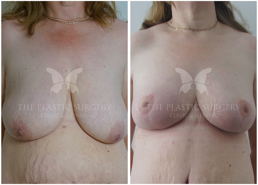 Breast reduction surgery, patient before and after (results) 47, Dr Chaithan Reddy