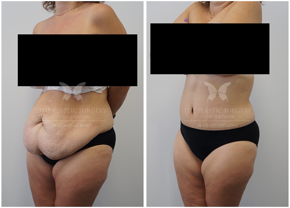 Mummy makeover plastic surgery, before and after 12, angle view