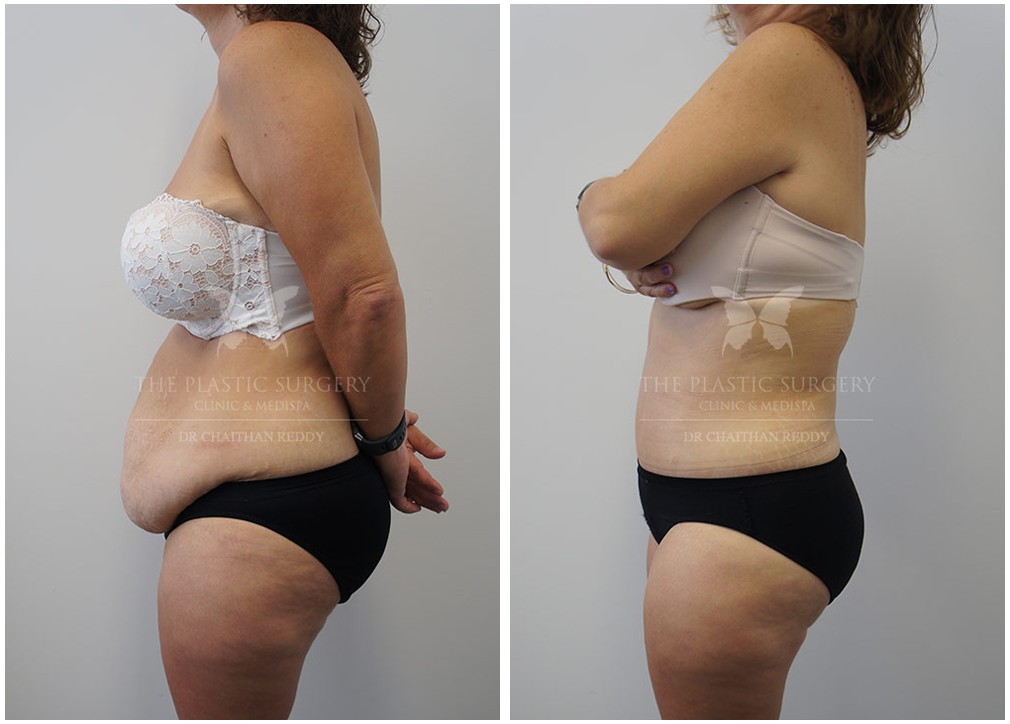 Mummy makeover before and after 13, Dr Reddy plastic surgery Sydney & Central Coast