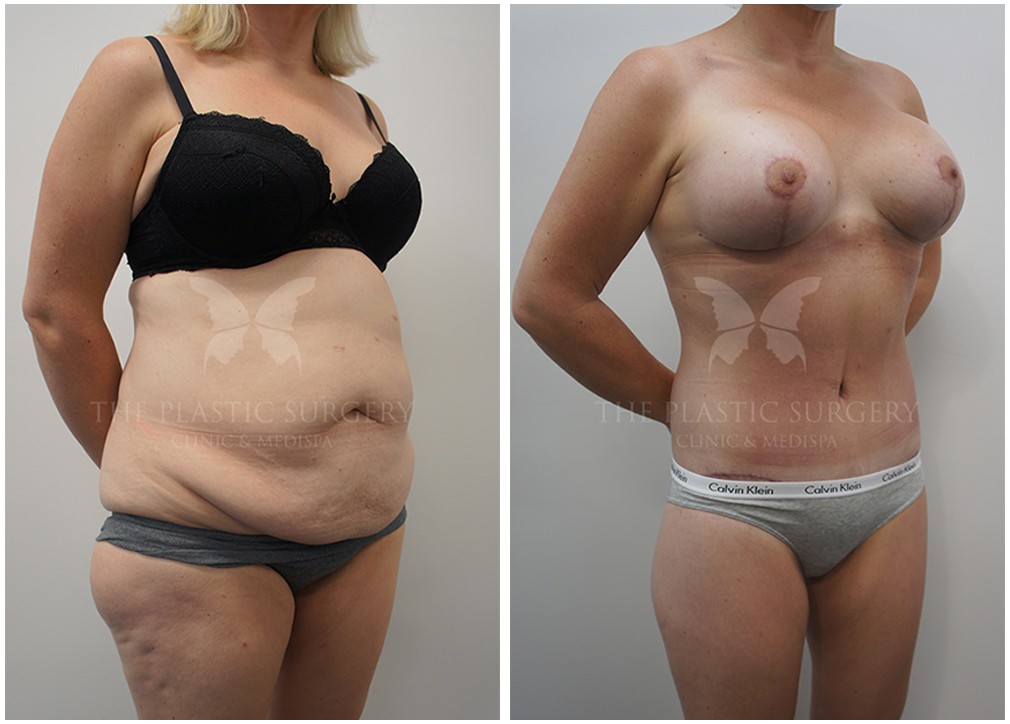 Patient before and after surgery 20, mummy makeover, angle view