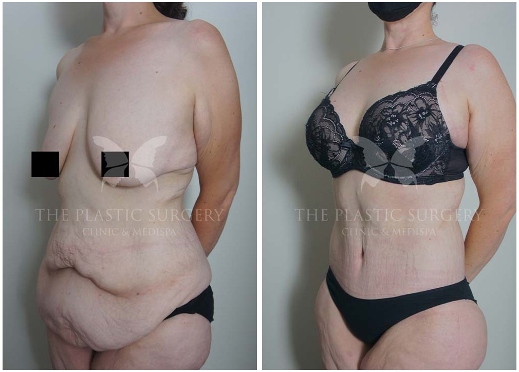 TPSC patient before and after post weight loss surgery 04, Dr Reddy