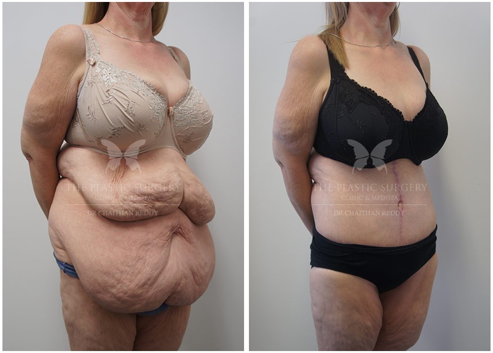 TPSC gallery, before and after post weight loss surgery 32, Dr Reddy