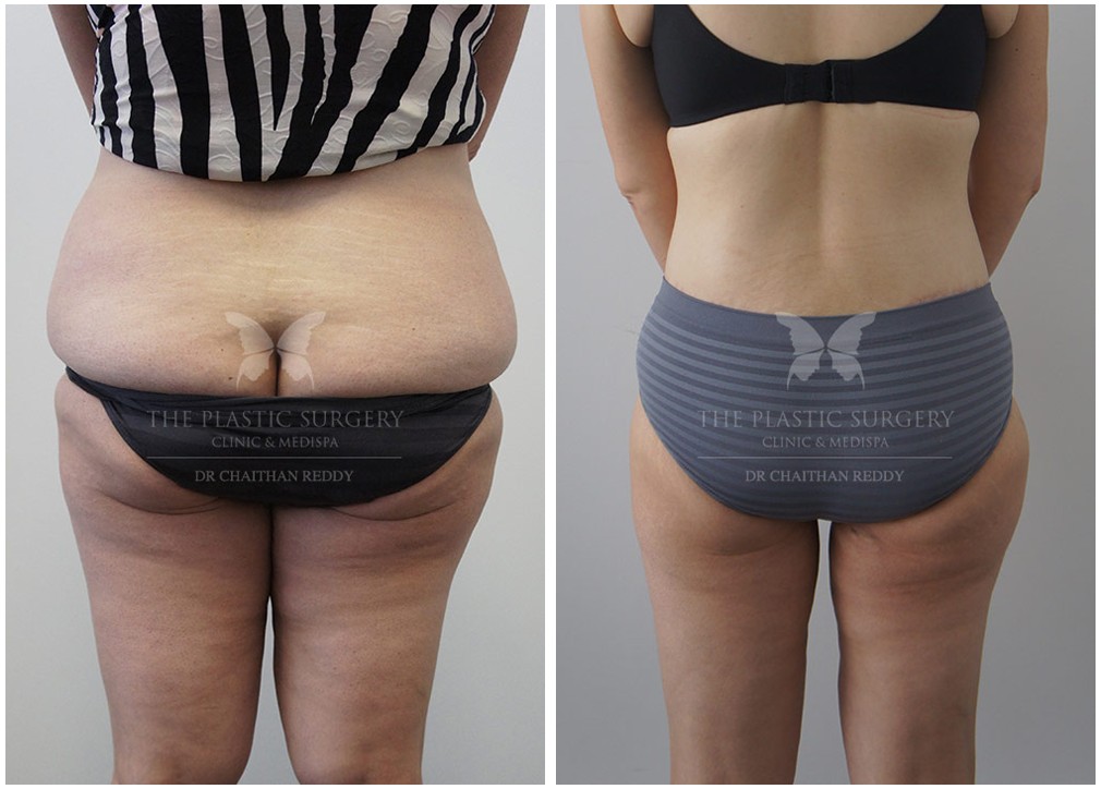 Before and after post weight loss surgery 50, Dr Reddy, back view