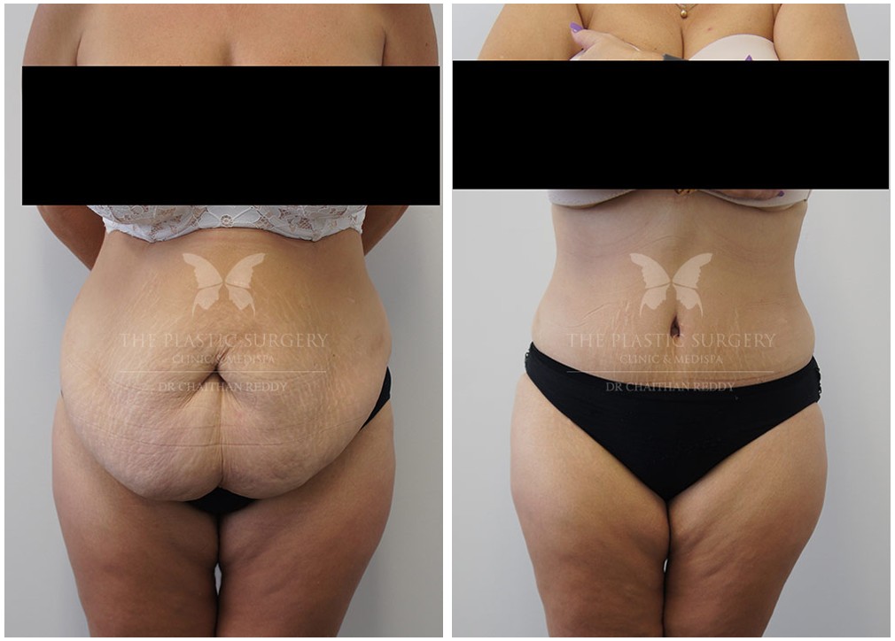 Before and afters 54, body lift and post weight loss surgery, The Plastic Surgery Clinic , front view