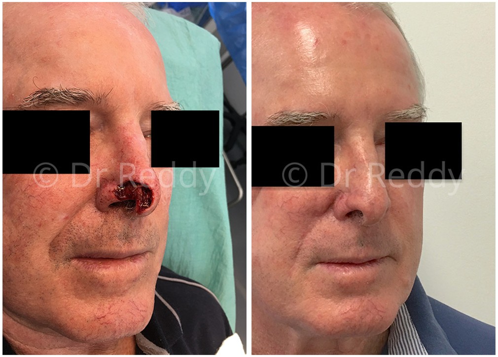 Before and afters 29, skin cancer removal, top nasal area, Dr Reddy