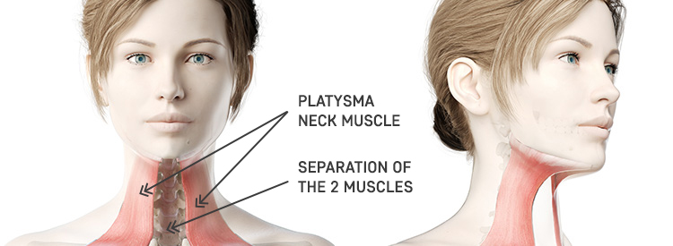 Neck lift procedure explained 01