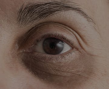 Blepharoplasty (eyelid surgery) model 01 TPSC